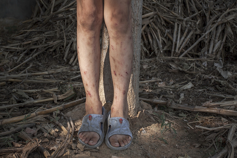 2008年7月2日，一个小伙伴腿上被蚊虫叮咬的伤痕累累，夏季村里蚊虫多，小伙们又喜欢扎堆乱窜，哪个身上都不轻快。作者：刘磊